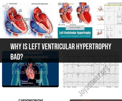 lv gram procedure|Dangers of Left Ventricular Hypertrophy .